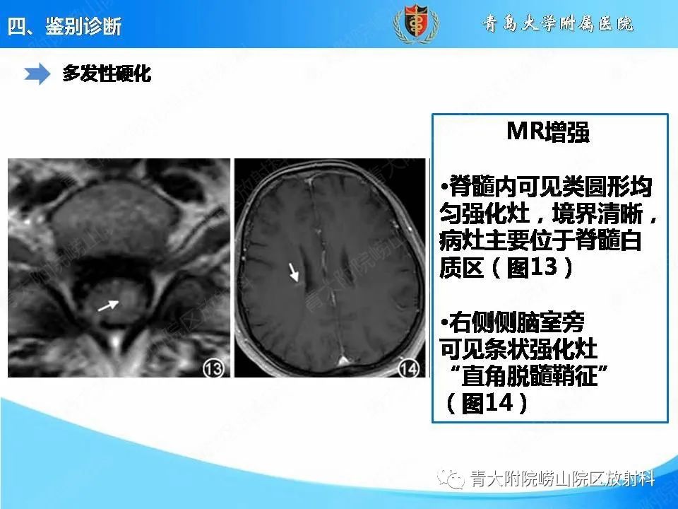 影像PPT - 【PPT】视神经脊髓炎谱系疾病的影像学诊断与鉴别诊断-23