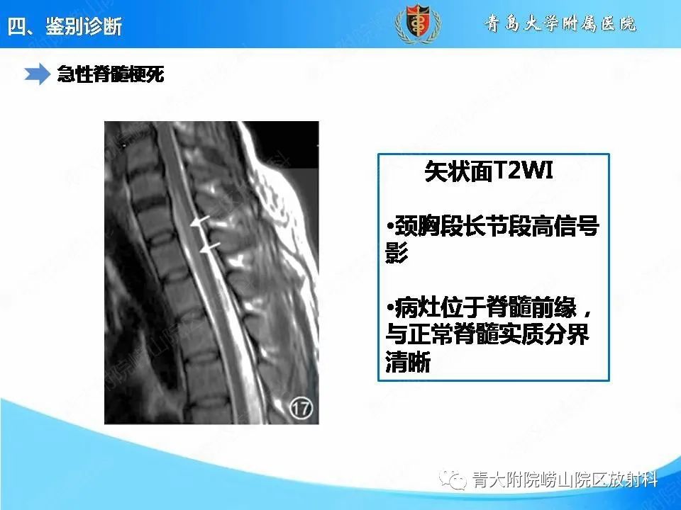 影像PPT - 【PPT】视神经脊髓炎谱系疾病的影像学诊断与鉴别诊断-29