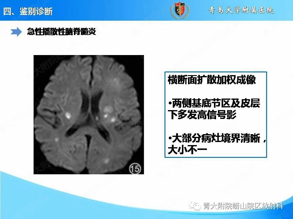 影像PPT - 【PPT】视神经脊髓炎谱系疾病的影像学诊断与鉴别诊断-25