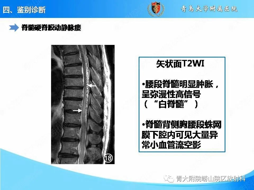 影像PPT - 【PPT】视神经脊髓炎谱系疾病的影像学诊断与鉴别诊断-31