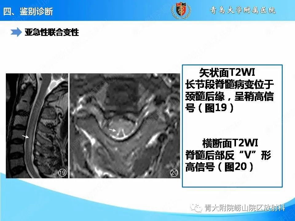 影像PPT - 【PPT】视神经脊髓炎谱系疾病的影像学诊断与鉴别诊断-33