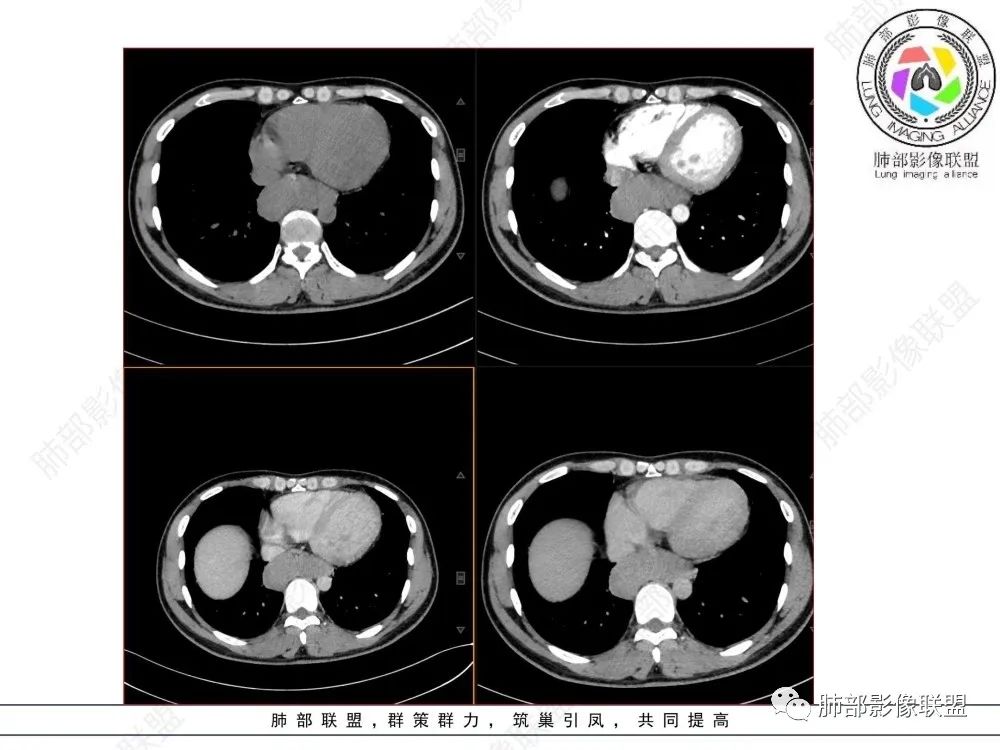 影像PPT - 【病例】后纵隔占位—食管平滑肌瘤1例X线CT及MR影像-9 影像PPT - 【病例】后纵隔占位—食管平滑肌瘤1例X线CT及MR影像-9