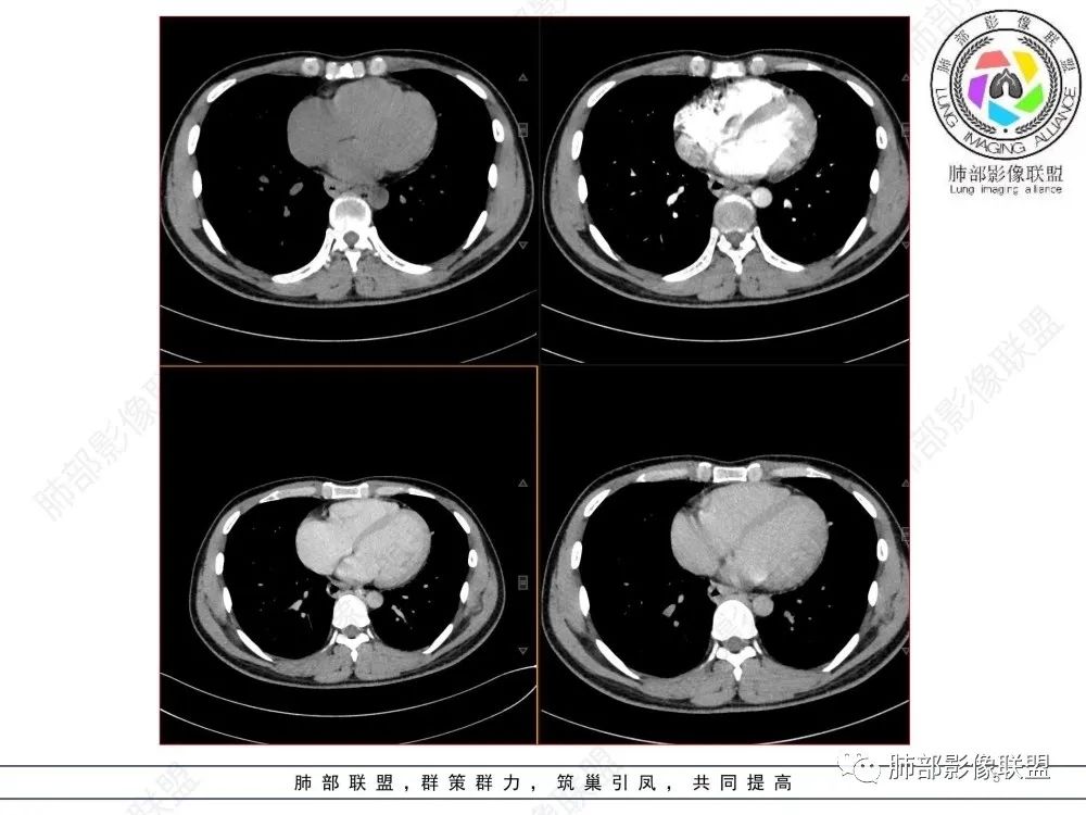 影像PPT - 【病例】后纵隔占位—食管平滑肌瘤1例X线CT及MR影像-5 影像PPT - 【病例】后纵隔占位—食管平滑肌瘤1例X线CT及MR影像-5