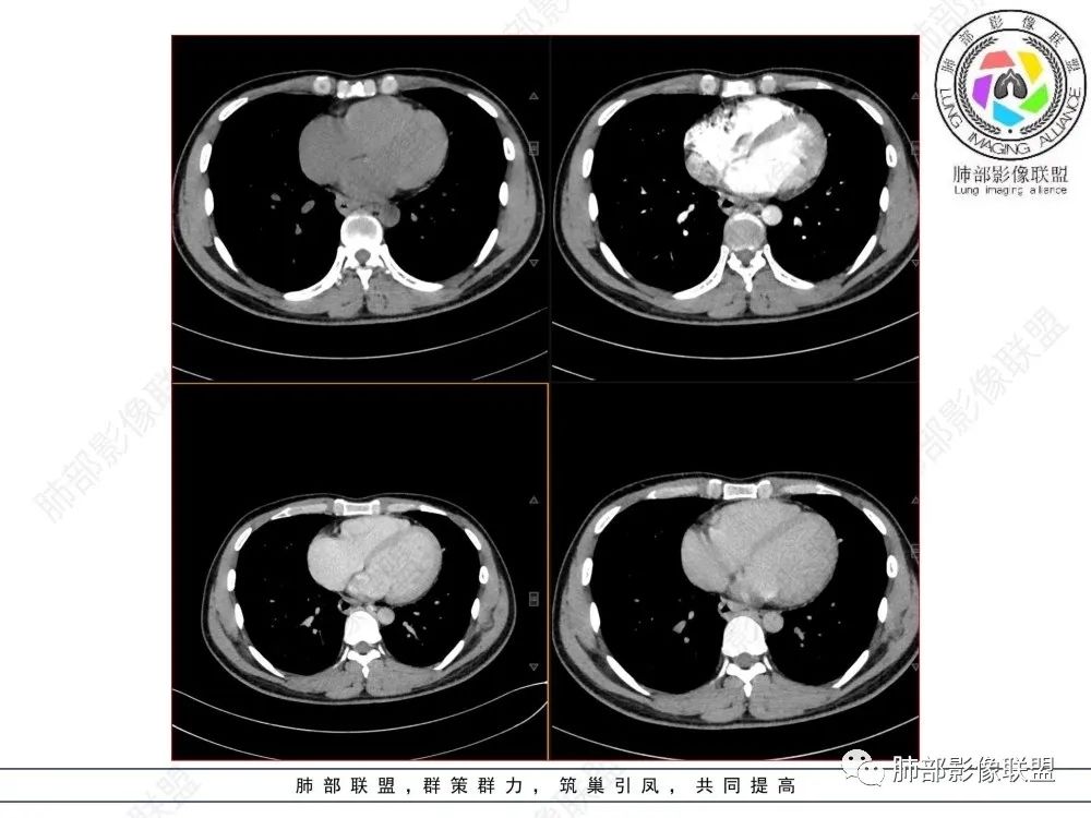 影像PPT - 【病例】后纵隔占位—食管平滑肌瘤1例X线CT及MR影像-6 影像PPT - 【病例】后纵隔占位—食管平滑肌瘤1例X线CT及MR影像-6