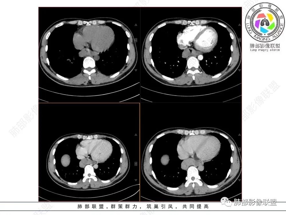 影像PPT - 【病例】后纵隔占位—食管平滑肌瘤1例X线CT及MR影像-8 影像PPT - 【病例】后纵隔占位—食管平滑肌瘤1例X线CT及MR影像-8