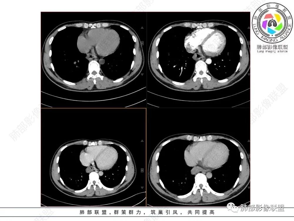 影像PPT - 【病例】后纵隔占位—食管平滑肌瘤1例X线CT及MR影像-7 影像PPT - 【病例】后纵隔占位—食管平滑肌瘤1例X线CT及MR影像-7