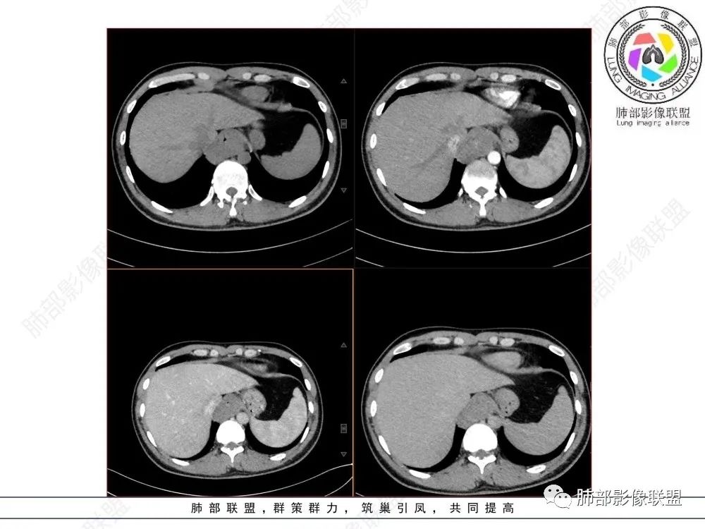 影像PPT - 【病例】后纵隔占位—食管平滑肌瘤1例X线CT及MR影像-15 影像PPT - 【病例】后纵隔占位—食管平滑肌瘤1例X线CT及MR影像-15