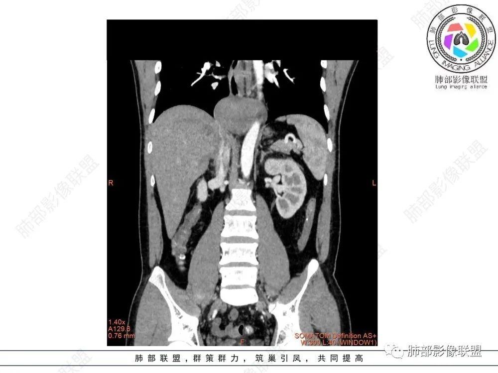 影像PPT - 【病例】后纵隔占位—食管平滑肌瘤1例X线CT及MR影像-20 影像PPT - 【病例】后纵隔占位—食管平滑肌瘤1例X线CT及MR影像-20