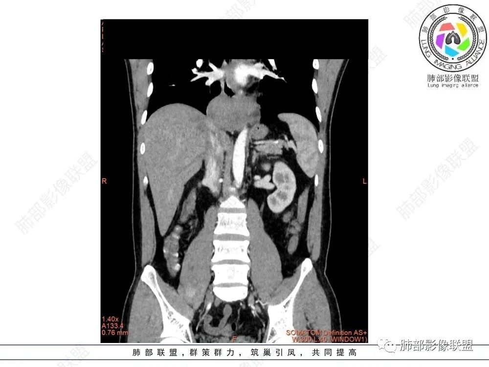 影像PPT - 【病例】后纵隔占位—食管平滑肌瘤1例X线CT及MR影像-21 影像PPT - 【病例】后纵隔占位—食管平滑肌瘤1例X线CT及MR影像-21