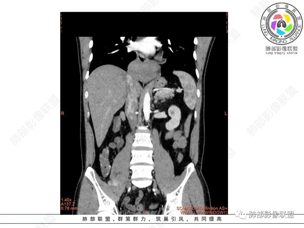 影像PPT - 【病例】后纵隔占位—食管平滑肌瘤1例X线CT及MR影像-22 影像PPT - 【病例】后纵隔占位—食管平滑肌瘤1例X线CT及MR影像-22
