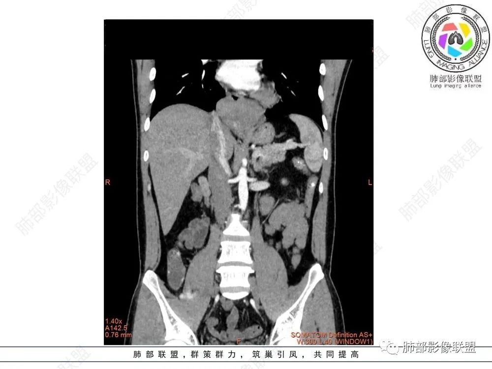 影像PPT - 【病例】后纵隔占位—食管平滑肌瘤1例X线CT及MR影像-23 影像PPT - 【病例】后纵隔占位—食管平滑肌瘤1例X线CT及MR影像-23
