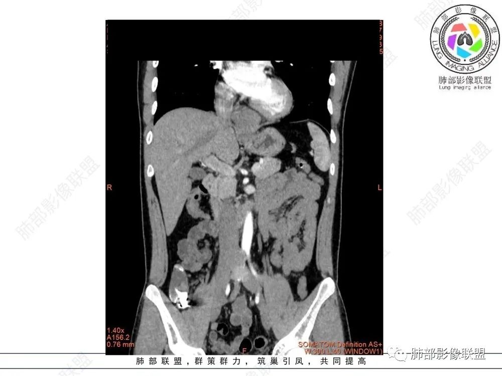 影像PPT - 【病例】后纵隔占位—食管平滑肌瘤1例X线CT及MR影像-25 影像PPT - 【病例】后纵隔占位—食管平滑肌瘤1例X线CT及MR影像-25