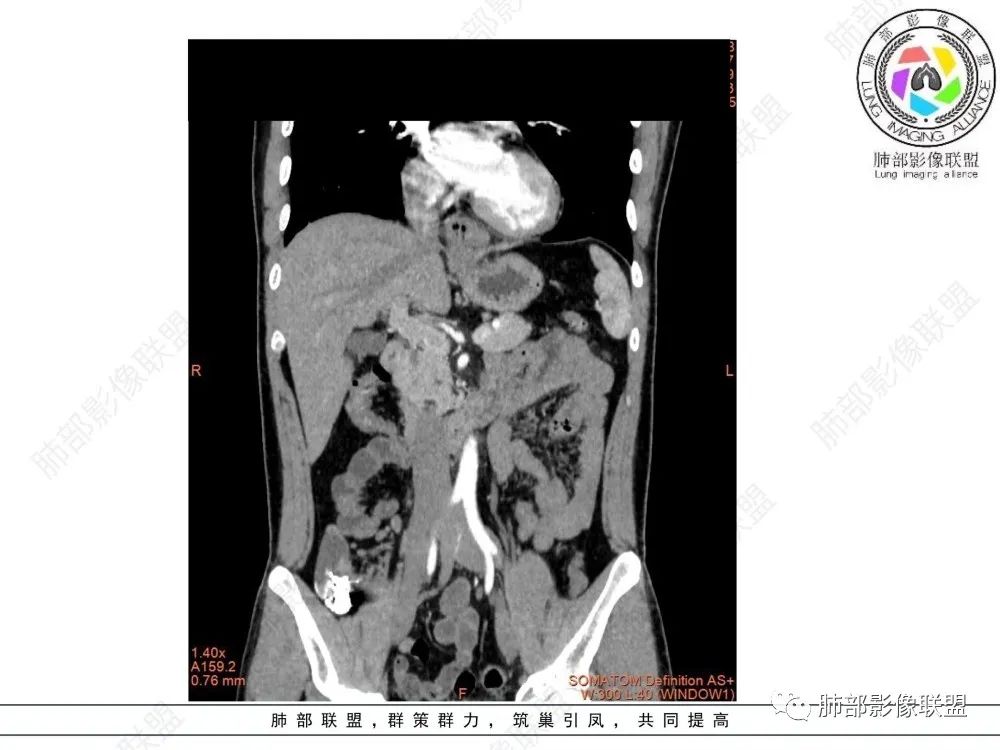 影像PPT - 【病例】后纵隔占位—食管平滑肌瘤1例X线CT及MR影像-26 影像PPT - 【病例】后纵隔占位—食管平滑肌瘤1例X线CT及MR影像-26