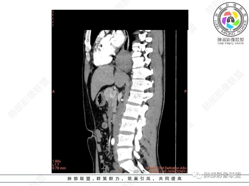 影像PPT - 【病例】后纵隔占位—食管平滑肌瘤1例X线CT及MR影像-28 影像PPT - 【病例】后纵隔占位—食管平滑肌瘤1例X线CT及MR影像-28