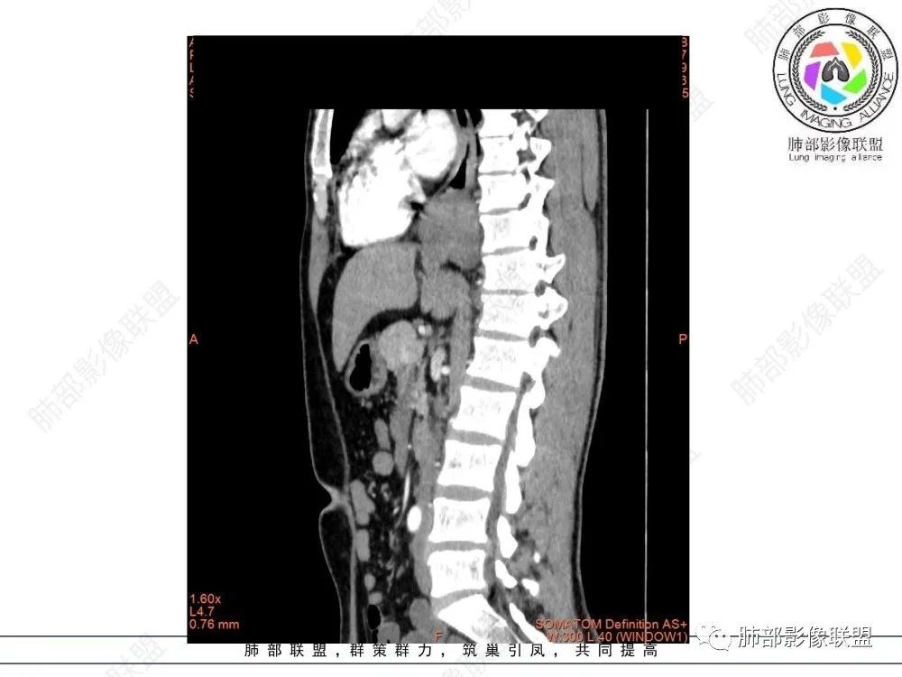 影像PPT - 【病例】后纵隔占位—食管平滑肌瘤1例X线CT及MR影像-29 影像PPT - 【病例】后纵隔占位—食管平滑肌瘤1例X线CT及MR影像-29