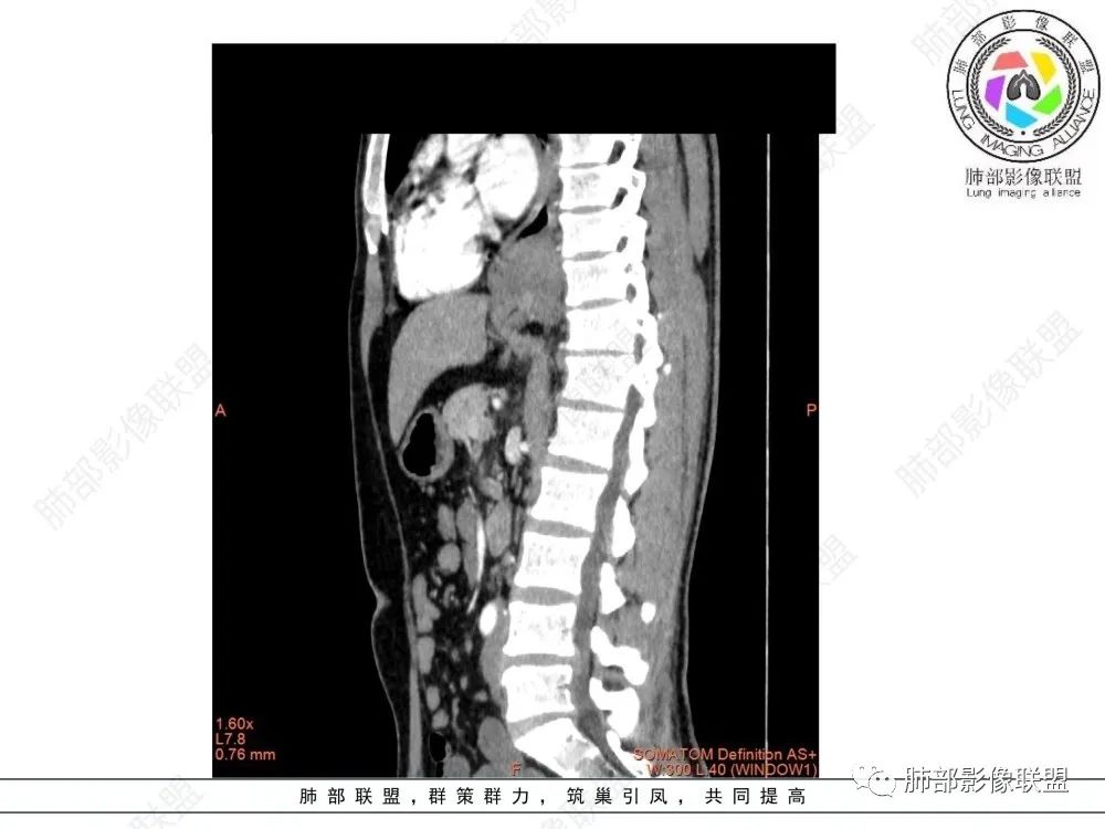 影像PPT - 【病例】后纵隔占位—食管平滑肌瘤1例X线CT及MR影像-30 影像PPT - 【病例】后纵隔占位—食管平滑肌瘤1例X线CT及MR影像-30