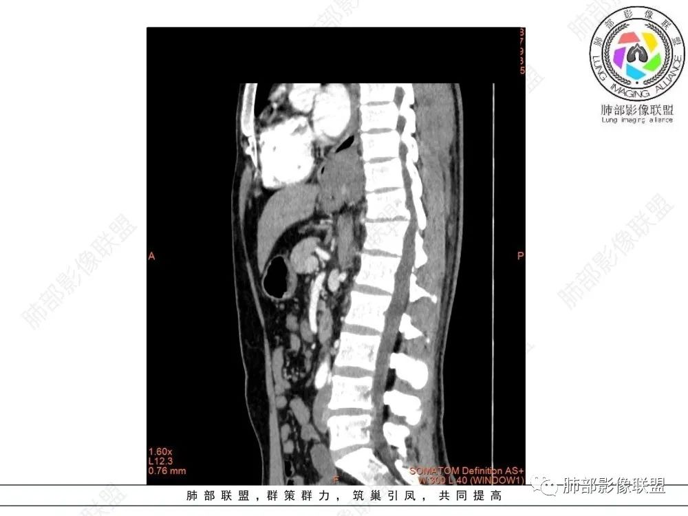 影像PPT - 【病例】后纵隔占位—食管平滑肌瘤1例X线CT及MR影像-31 影像PPT - 【病例】后纵隔占位—食管平滑肌瘤1例X线CT及MR影像-31