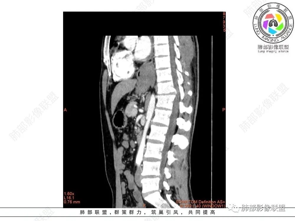 影像PPT - 【病例】后纵隔占位—食管平滑肌瘤1例X线CT及MR影像-32 影像PPT - 【病例】后纵隔占位—食管平滑肌瘤1例X线CT及MR影像-32
