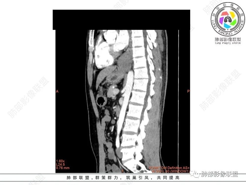 影像PPT - 【病例】后纵隔占位—食管平滑肌瘤1例X线CT及MR影像-34 影像PPT - 【病例】后纵隔占位—食管平滑肌瘤1例X线CT及MR影像-34