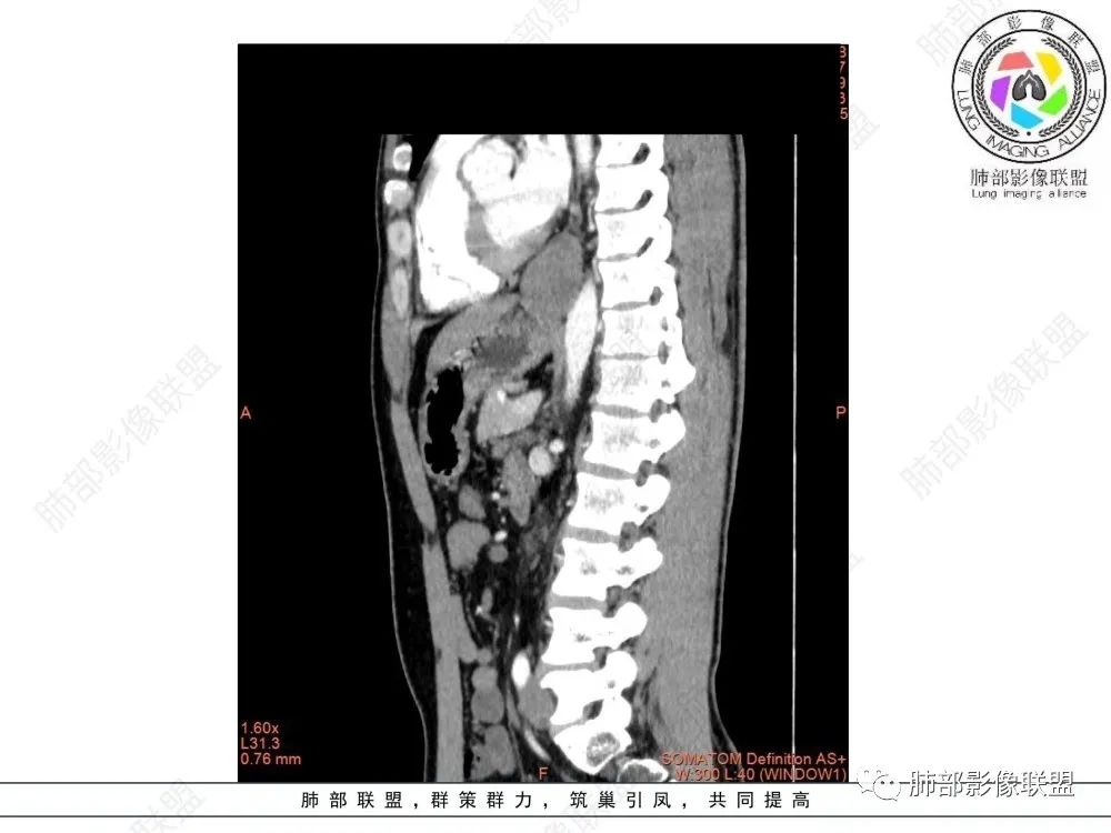 影像PPT - 【病例】后纵隔占位—食管平滑肌瘤1例X线CT及MR影像-36 影像PPT - 【病例】后纵隔占位—食管平滑肌瘤1例X线CT及MR影像-36