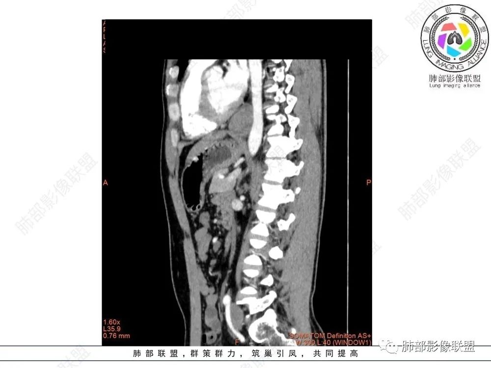 影像PPT - 【病例】后纵隔占位—食管平滑肌瘤1例X线CT及MR影像-37 影像PPT - 【病例】后纵隔占位—食管平滑肌瘤1例X线CT及MR影像-37
