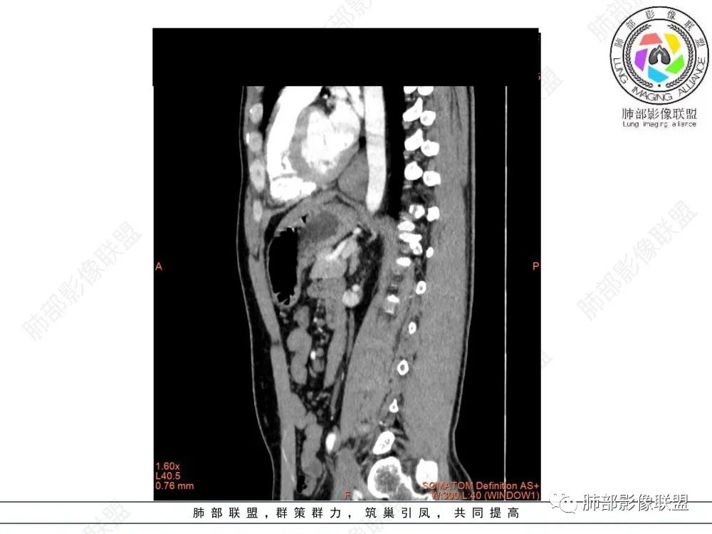 影像PPT - 【病例】后纵隔占位—食管平滑肌瘤1例X线CT及MR影像-38 影像PPT - 【病例】后纵隔占位—食管平滑肌瘤1例X线CT及MR影像-38