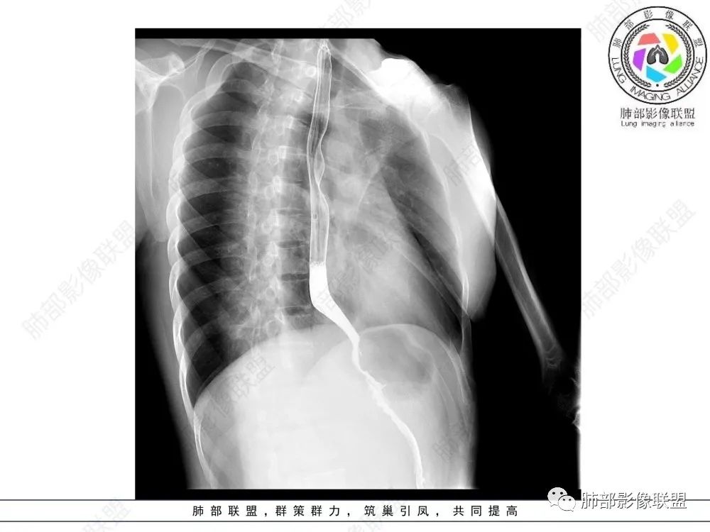 影像PPT - 【病例】后纵隔占位—食管平滑肌瘤1例X线CT及MR影像-39 影像PPT - 【病例】后纵隔占位—食管平滑肌瘤1例X线CT及MR影像-39