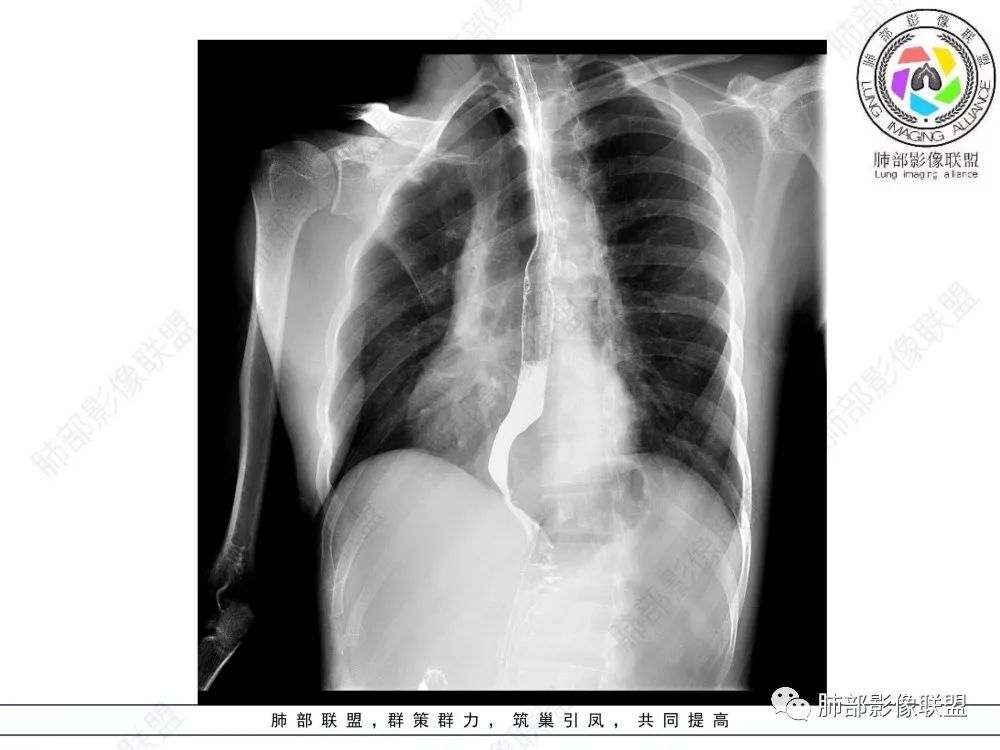 影像PPT - 【病例】后纵隔占位—食管平滑肌瘤1例X线CT及MR影像-40 影像PPT - 【病例】后纵隔占位—食管平滑肌瘤1例X线CT及MR影像-40
