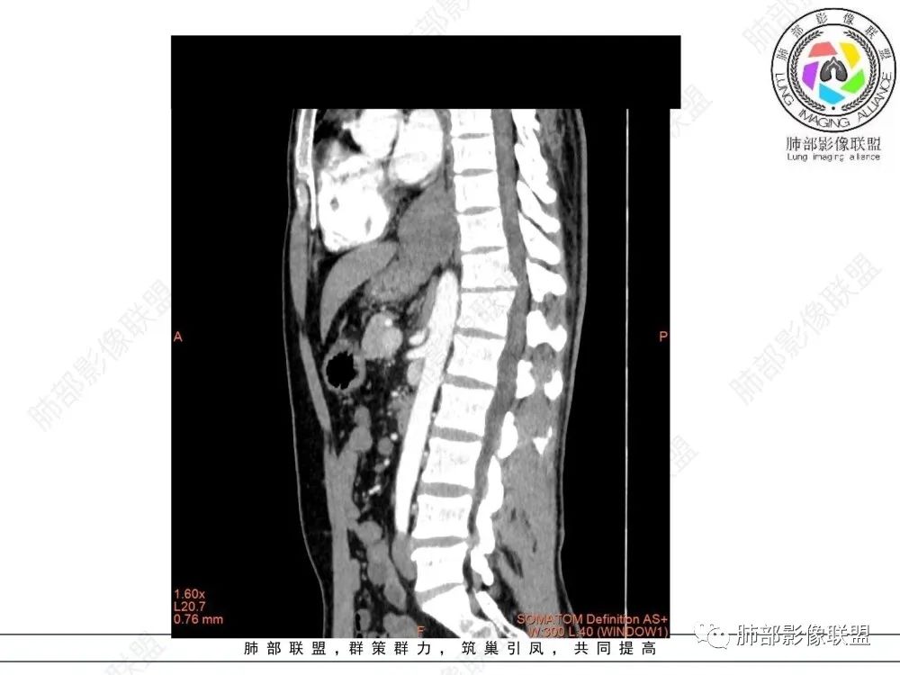 影像PPT - 【病例】后纵隔占位—食管平滑肌瘤1例X线CT及MR影像-33 影像PPT - 【病例】后纵隔占位—食管平滑肌瘤1例X线CT及MR影像-33
