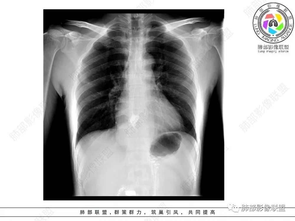 影像PPT - 【病例】后纵隔占位—食管平滑肌瘤1例X线CT及MR影像-41 影像PPT - 【病例】后纵隔占位—食管平滑肌瘤1例X线CT及MR影像-41