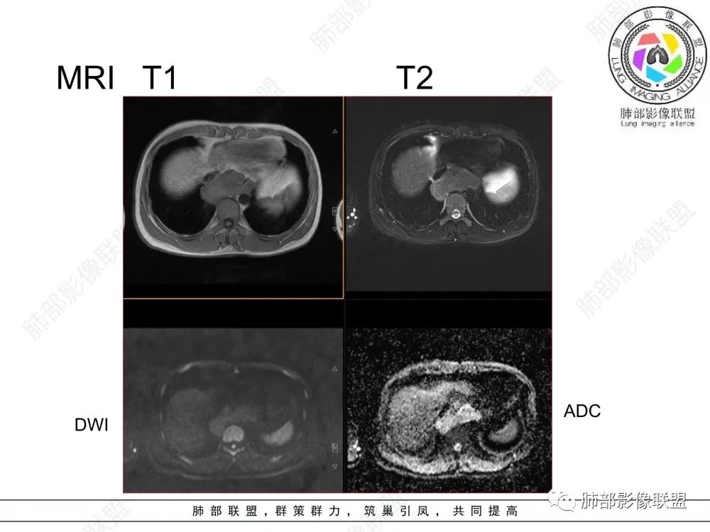 影像PPT - 【病例】后纵隔占位—食管平滑肌瘤1例X线CT及MR影像-43 影像PPT - 【病例】后纵隔占位—食管平滑肌瘤1例X线CT及MR影像-43