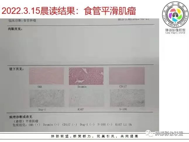 影像PPT - 【病例】后纵隔占位—食管平滑肌瘤1例X线CT及MR影像-49 影像PPT - 【病例】后纵隔占位—食管平滑肌瘤1例X线CT及MR影像-49