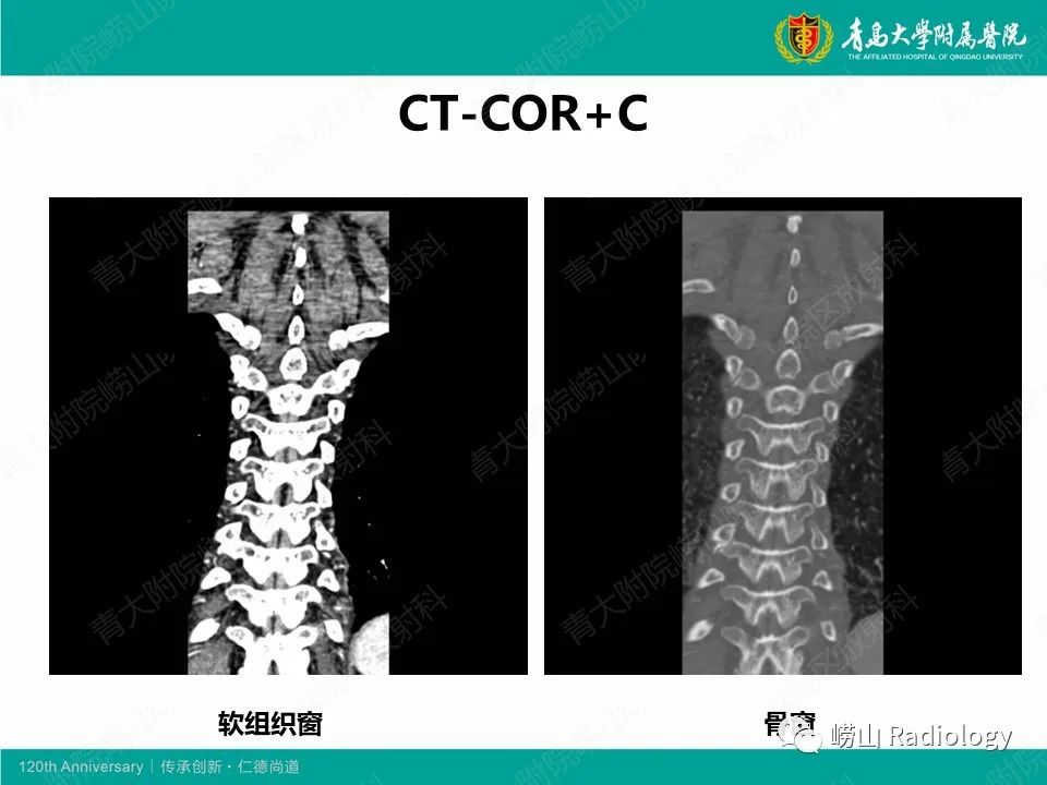 影像PPT - 【病例】脊椎结核1例CT及MR-5