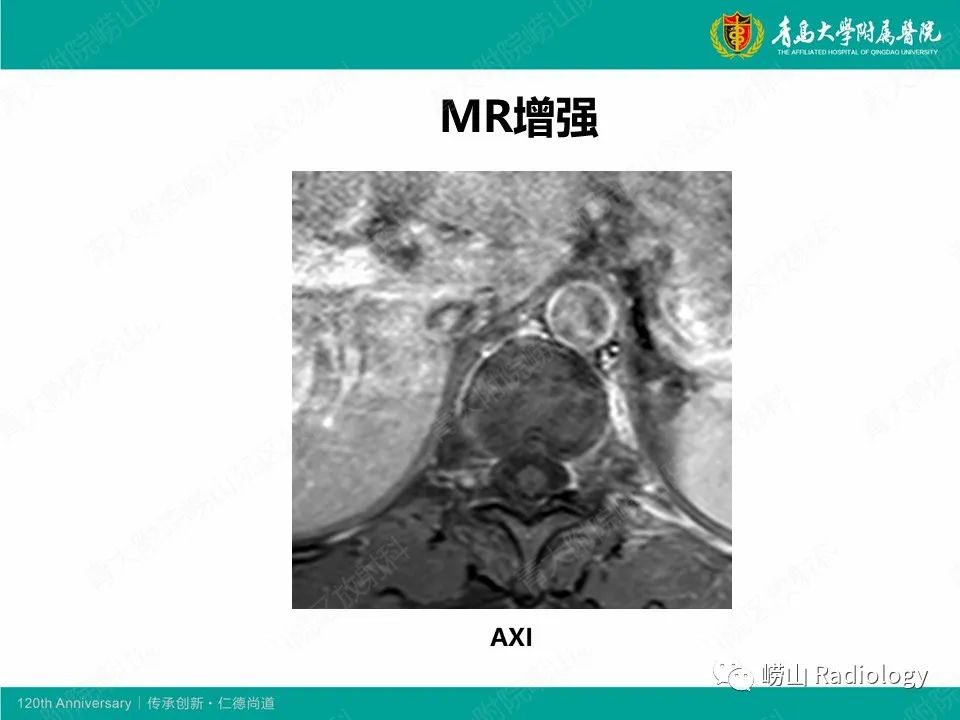 影像PPT - 【病例】脊椎结核1例CT及MR-6