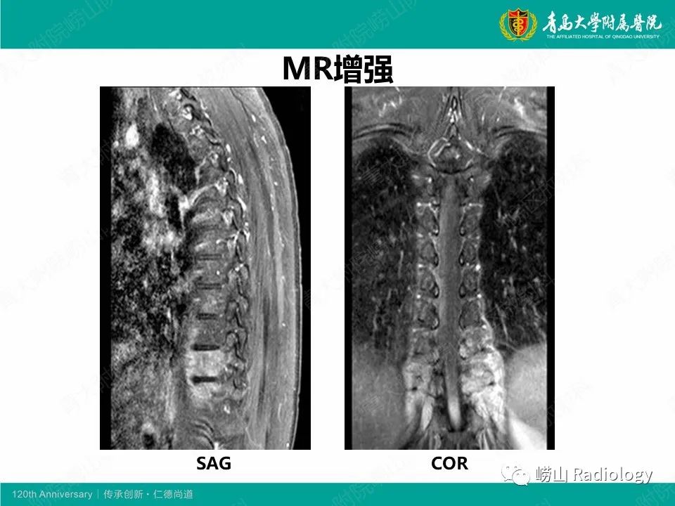 影像PPT - 【病例】脊椎结核1例CT及MR-7