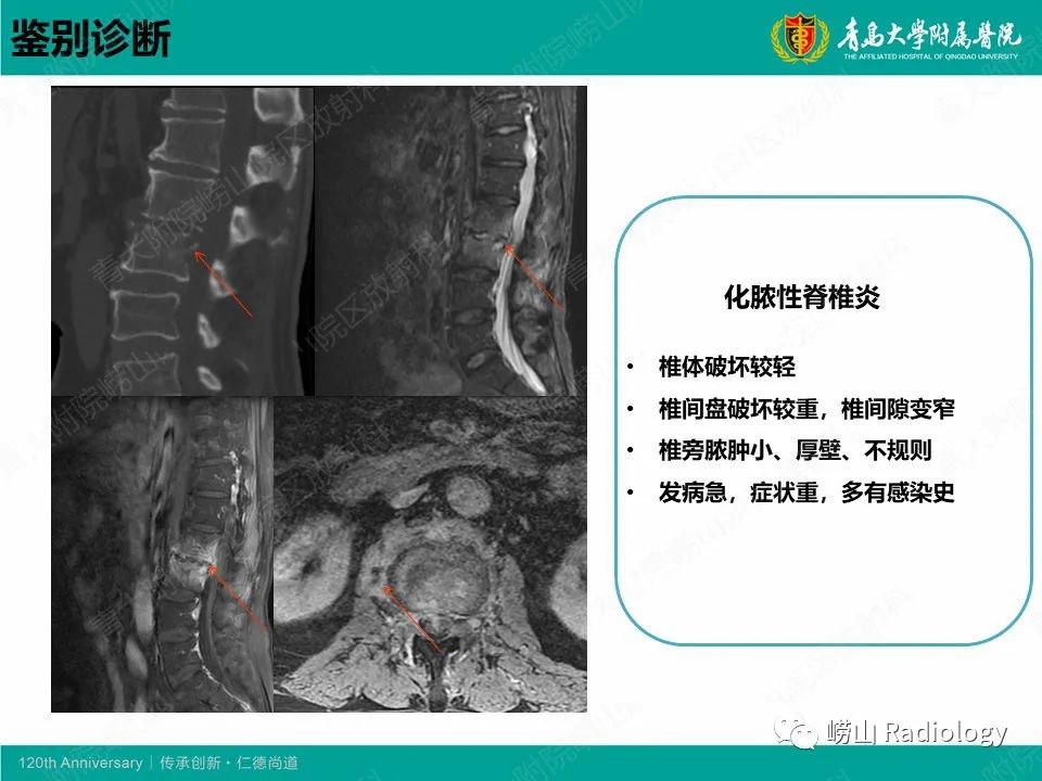 影像PPT - 【病例】脊椎结核1例CT及MR-13