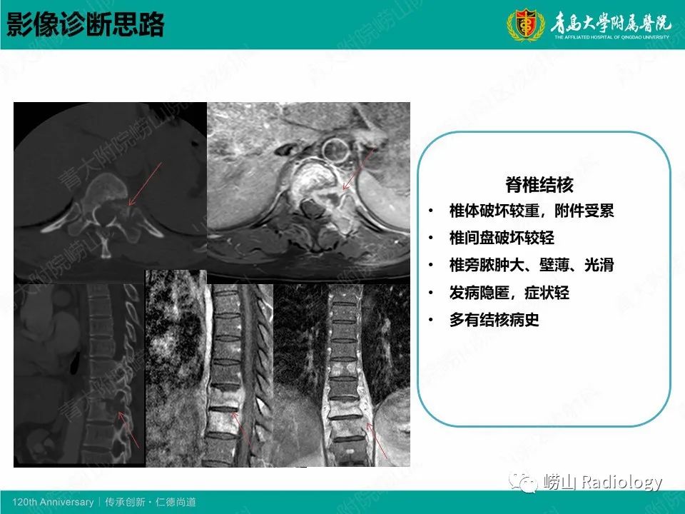 影像PPT - 【病例】脊椎结核1例CT及MR-12