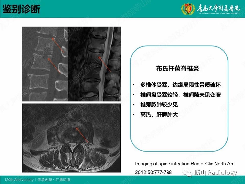 影像PPT - 【病例】脊椎结核1例CT及MR-14