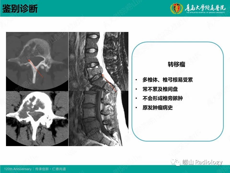 影像PPT - 【病例】脊椎结核1例CT及MR-15