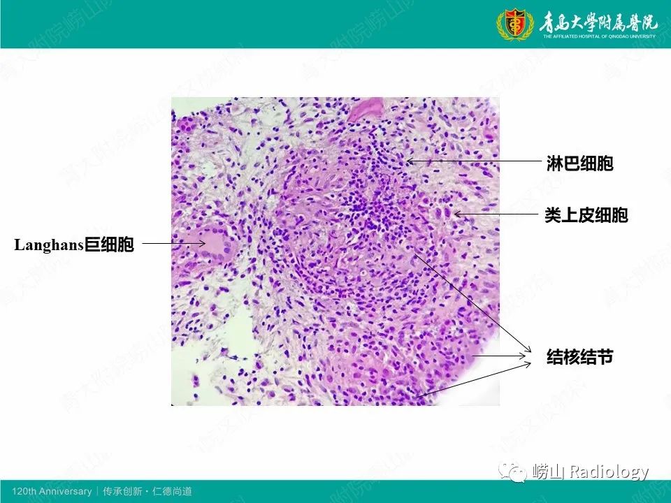 影像PPT - 【病例】脊椎结核1例CT及MR-10