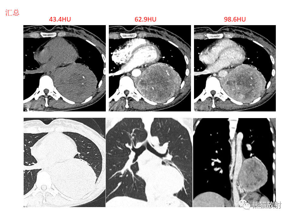影像PPT - 【病例】胸膜孤立性纤维瘤2例CT影像-18