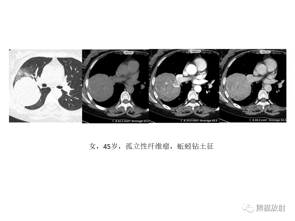 影像PPT - 【病例】胸膜孤立性纤维瘤2例CT影像-28