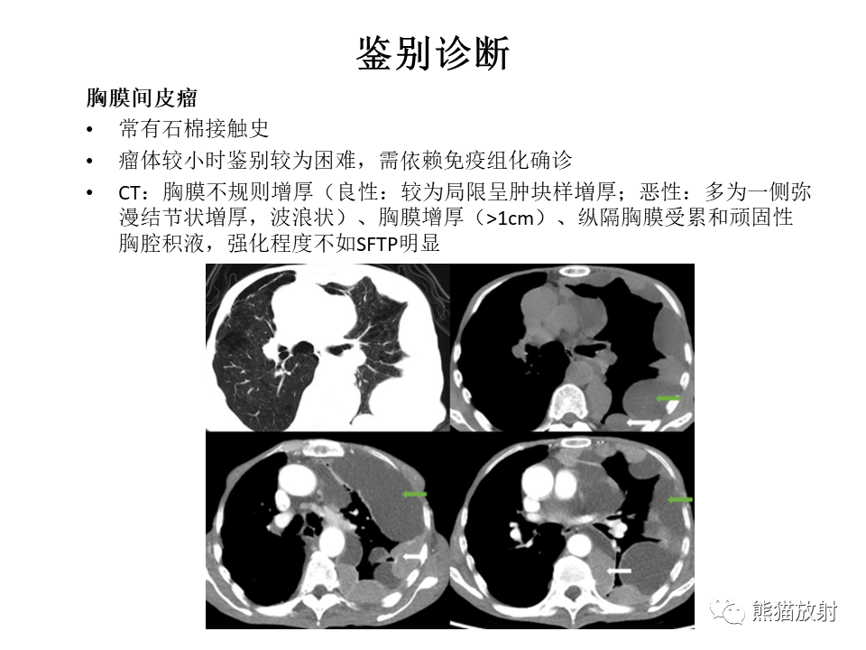 影像PPT - 【病例】胸膜孤立性纤维瘤2例CT影像-30