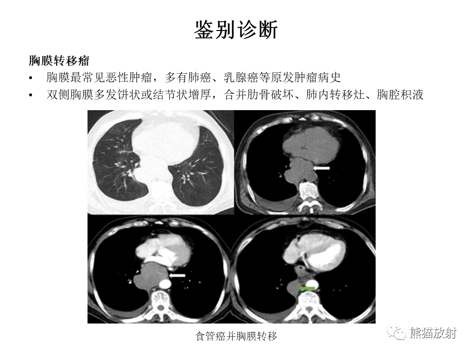 影像PPT - 【病例】胸膜孤立性纤维瘤2例CT影像-31
