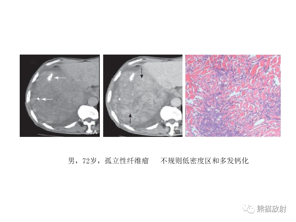 影像PPT - 【病例】胸膜孤立性纤维瘤2例CT影像-29