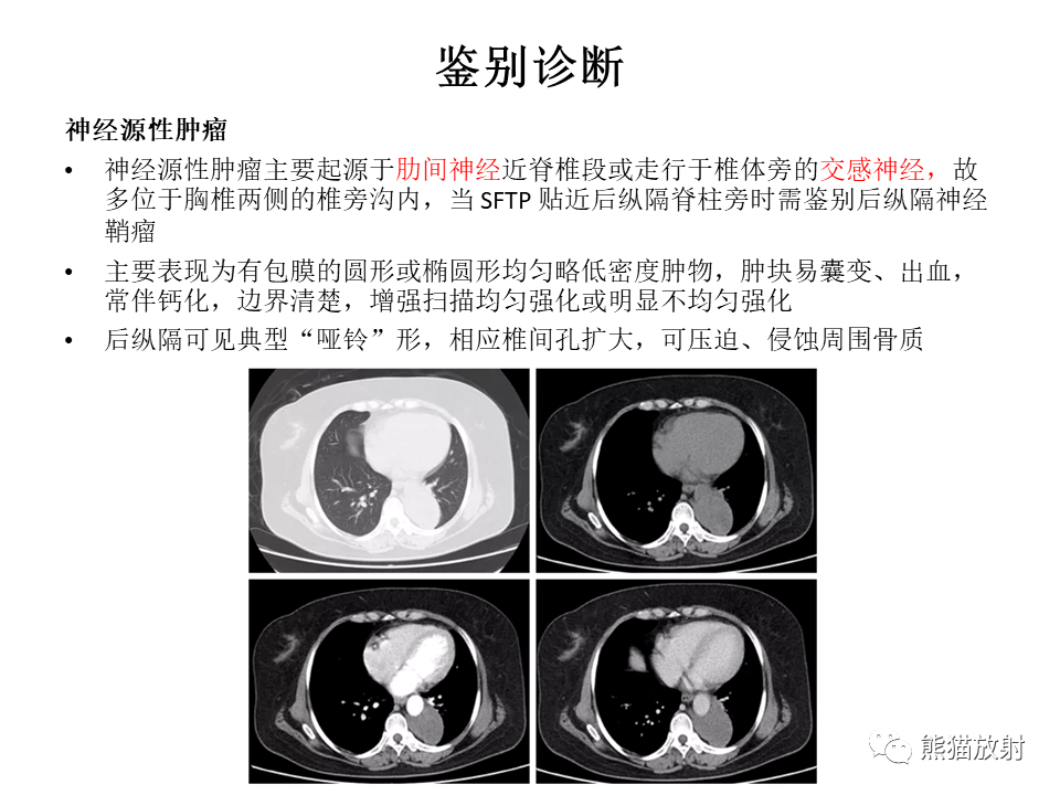 影像PPT - 【病例】胸膜孤立性纤维瘤2例CT影像-32