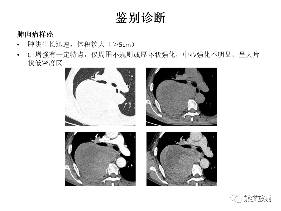 影像PPT - 【病例】胸膜孤立性纤维瘤2例CT影像-33