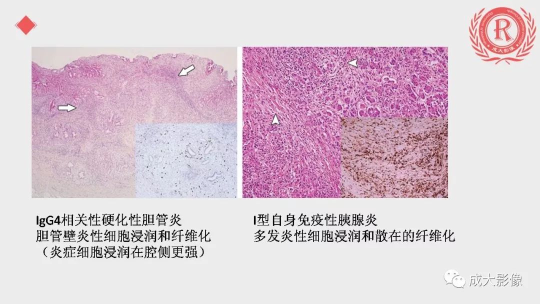 影像PPT - 【PPT】“对应性胆系胰腺疾病”的影像表现-10 影像PPT - 【PPT】“对应性胆系胰腺疾病”的影像表现-10