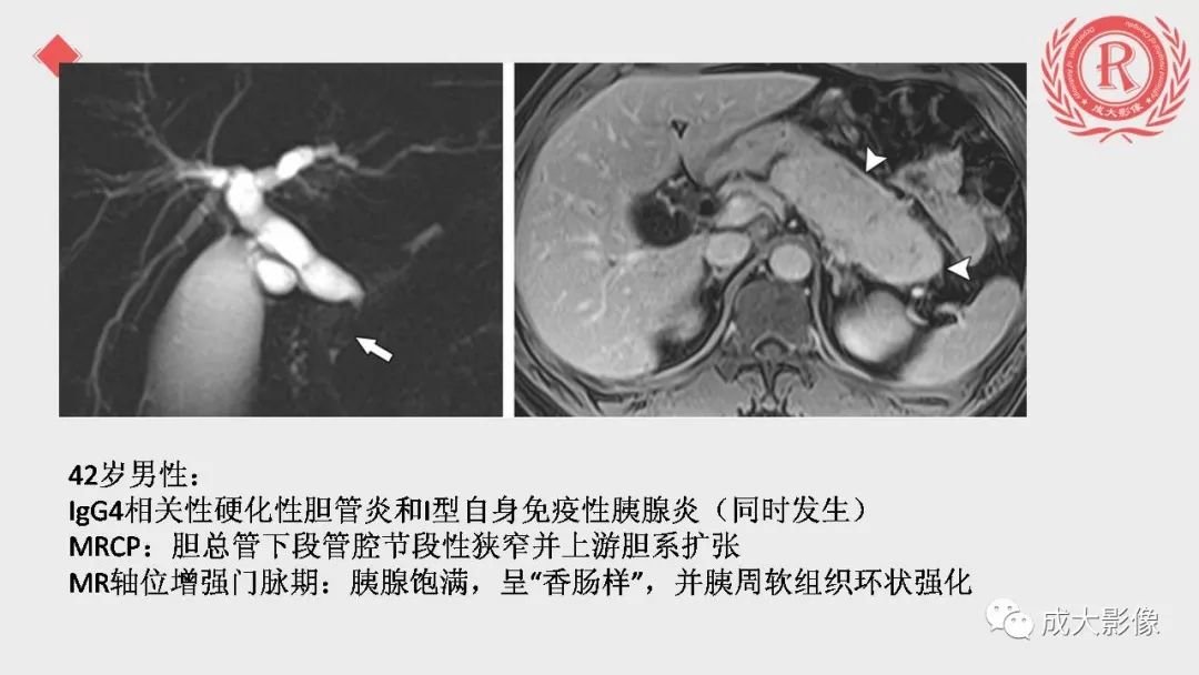 影像PPT - 【PPT】“对应性胆系胰腺疾病”的影像表现-11 影像PPT - 【PPT】“对应性胆系胰腺疾病”的影像表现-11