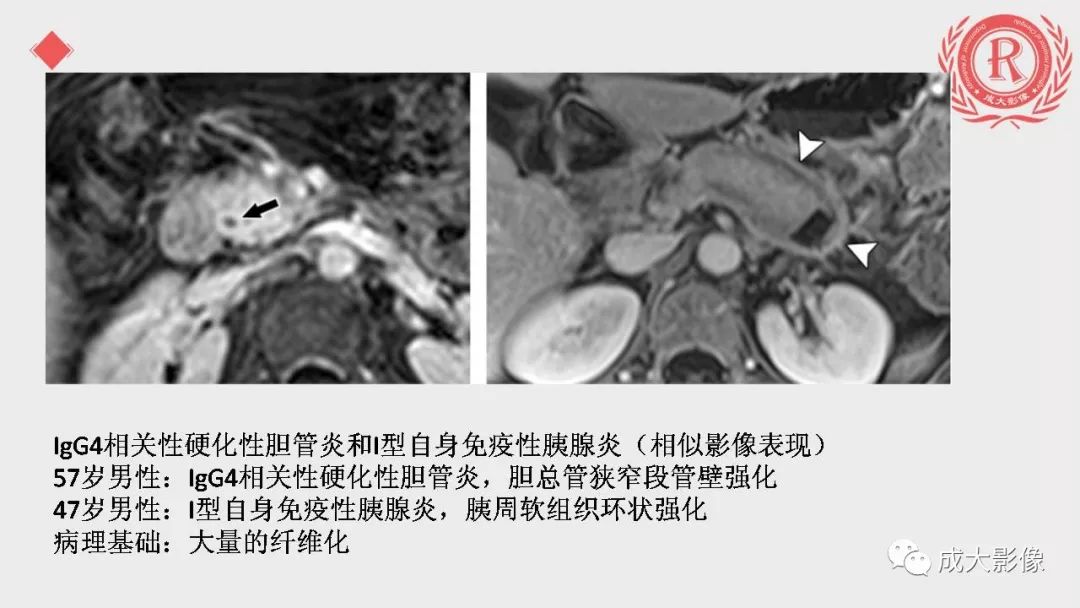 影像PPT - 【PPT】“对应性胆系胰腺疾病”的影像表现-12 影像PPT - 【PPT】“对应性胆系胰腺疾病”的影像表现-12